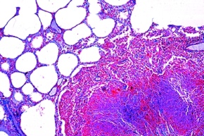 Mikropräparat - Miliartuberkulose der Lunge, Pathologische Veränderungen der Lunge und der Leber, Tuberkulose und Lungenentzündung