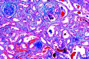 Mikropräparat - Chronische Glomerulonephritis, Reaktionen der Nieren bei Arteriosklerose, Stoffwechselstörungen und Entzündungen, Dickdarmentzündung