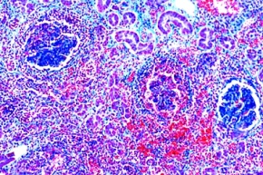 Mikropräparat - Embolische, nicht eitrige Glomerulonephritis, Reaktionen der Nieren bei Arteriosklerose, Stoffwechselstörungen und Entzündungen, Dickdarmentzündung