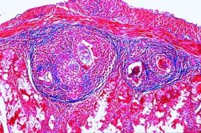 Mikropräparat - Schistosoma mansoni, Eier im Schnitt durch Leber oder Darm