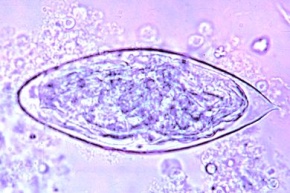 Mikropräparat - Schistosoma haematobium, Eier im Urinsediment