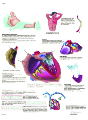 Anatomische Lehrtafel, häufige Herzerkrankungen